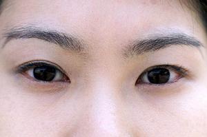 札幌で二重にする手術を行う場合の注意点